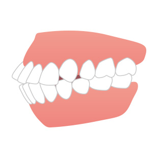 口ゴボ<br>(上下顎前突)